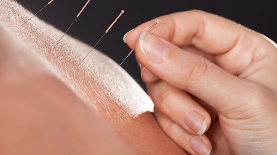 acupuncture benefits 1