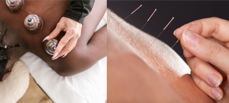 Dry cupping vs dry needling